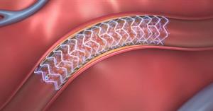 Absorbstent1 Absorb Dissolving Heart Stent2